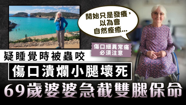小傷口變大病｜疑睡覺時被蟲咬 傷口潰爛小腿壞死 69歲婆婆急截雙腿保命