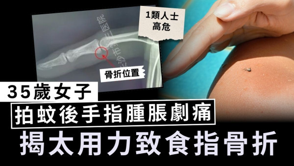 骨質疏鬆｜35歲女子拍蚊後手指腫脹劇痛 揭太用力致食指骨折