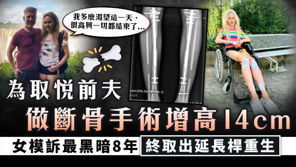 增高手術｜為取悅前夫做斷骨手術增高14cm 女模訴最黑暗8年終取出延長桿重生