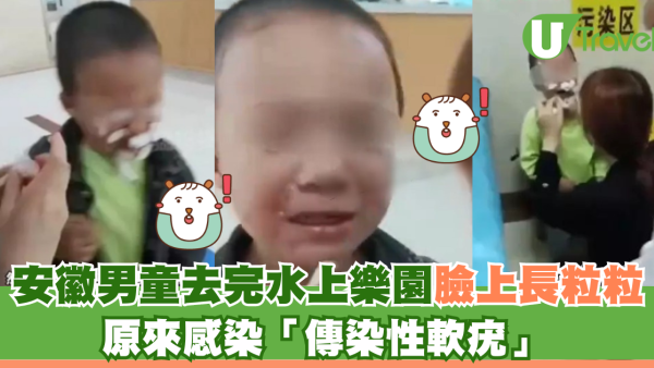 安徽男童去完水上樂園臉上長粒粒 原來感染「傳染性軟疣」 