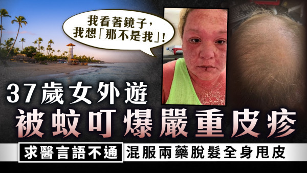 外遊求診｜37歲女外遊被蚊叮引發嚴重皮疹 求醫言語不通混服兩藥脫髮全身甩皮　