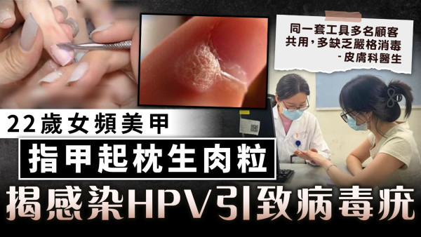 美甲危機︱22歲女頻美甲 指甲起枕生肉粒 揭感染HPV引致病毒疣