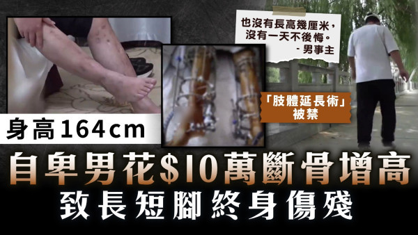 高危手術｜身高164cm自卑男花$10萬斷骨增高 致長短腳終身傷殘