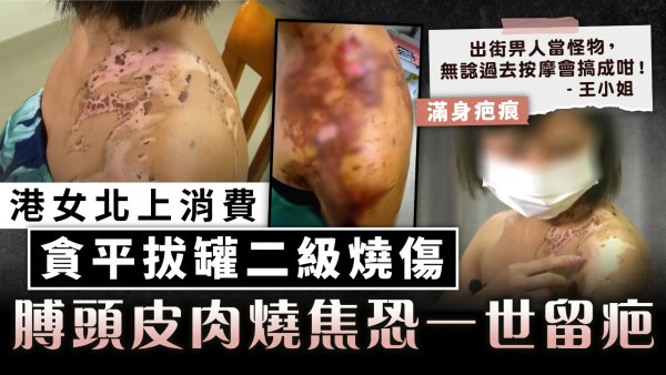 北上消費｜港女上深圳貪平拔罐二級燒傷 膊頭皮肉燒焦恐一世留疤