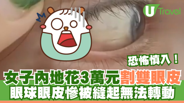恐怖慎入｜女子內地花3萬元割雙眼皮 眼球眼皮慘被縫起無法轉動