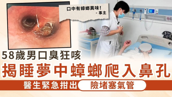 家居衛生｜58歲男口臭狂咳 揭睡夢中蟑螂爬入鼻孔 醫生緊急拑出險堵塞氣管