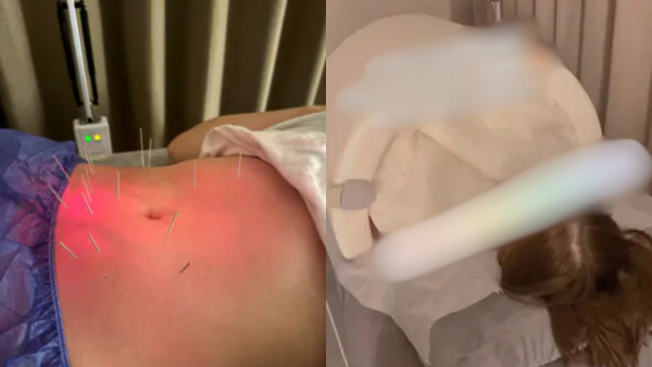 港女做暖宮療程慘被燒傷留疤！涉事診所只願賠500蚊？事主直言︰簡直係侮辱...