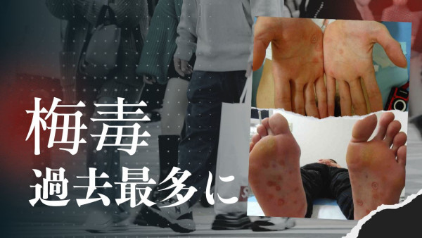 遊日注意！日本東京梅毒病例創新高！4階段症狀！附專家3大預防建議