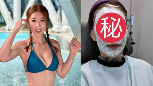 TVB咪神陳婉衡大方公開韓國醫美打針  手術後皮膚狀態嚇窒網民！