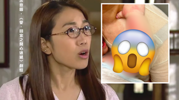 外傭疑報復 滾粥燙傷BB！嚴重灼傷致手至半身紅腫脫皮！港爸心痛：醫生話可能要植皮