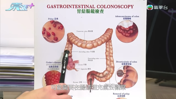港婦私家做大腸鏡檢查「照爆腸」 急症入院方知要切腸掛便袋 苦主：無提過風險！