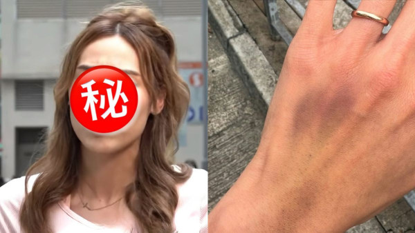 再有東張女神採訪遇襲受傷惹「搏流量」質疑 本尊晒傷勢圖千字文爆seed回應