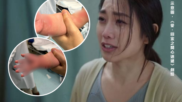 6個月大女嬰被熱水燙傷至脫皮！菲傭稱BB整瀉水壺 醫生指屬意外無法報警？事件後續咁發展...