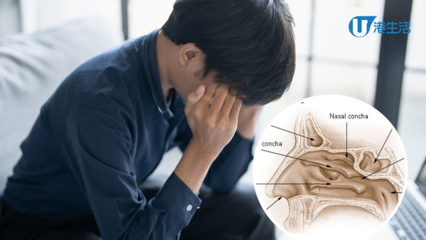 頭痛大半年原來是鼻竇炎作怪！小心嗆咳、過敏引發深層危機