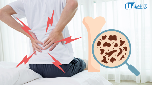 27歲男腰痛 患嚴重骨質疏鬆！4大壞習慣釀禍 醫生教6招預防
