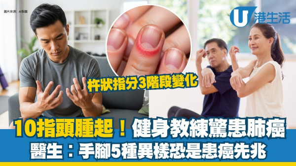 「杵狀指」十隻手指頭腫脹竟是肺癌三期！手腳5種異樣當心早期癌症警號