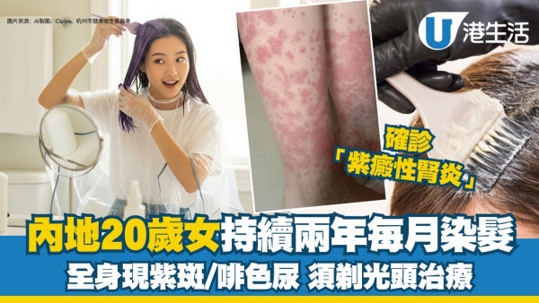 染髮傷腎？內地20歲女連續2年每月染頭髮 全身突冒紫斑！醫生籲剃光頭保命
