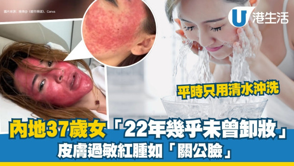 化妝不卸妝︱內地女自稱「22年不卸妝」 皮膚過敏紅腫如「關公臉」 ︰像硬殼一樣！