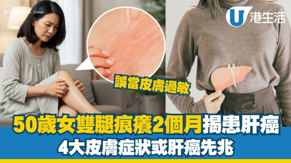 50歲女雙腿皮膚痕癢2個月體檢揭患肝癌 醫生籲皮膚4異狀要小心！