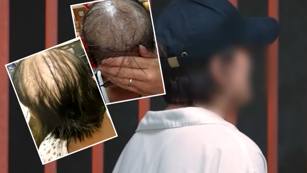 貪靚港女醫「鬼剃頭」打針生髮慘變禿頭 怒控診所不負責任：我36歲你搞到我似66歲！