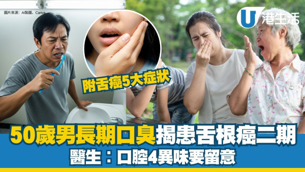 50歲男長期口臭誤以為扁桃腺結石 求醫揭患舌根癌二期 醫生︰4異味要留意！