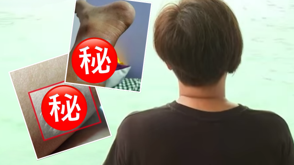 港媽「薑球按摩」慘變二級燒傷！傷口焦黑切腐肉「痛過生仔」涉事美容院回覆惹眾怒