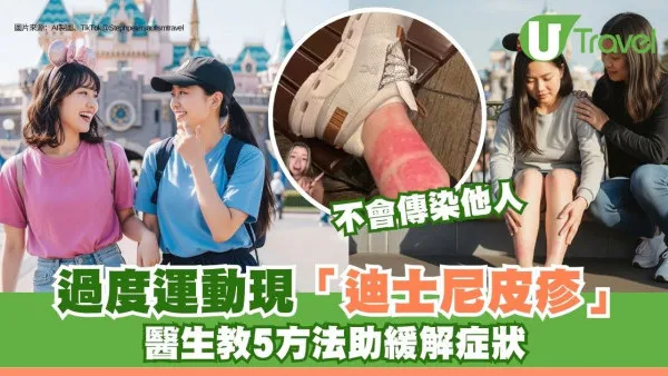 過度運動現「迪士尼皮疹」？醫生教5方法助緩解 50歲以上女性常發生！