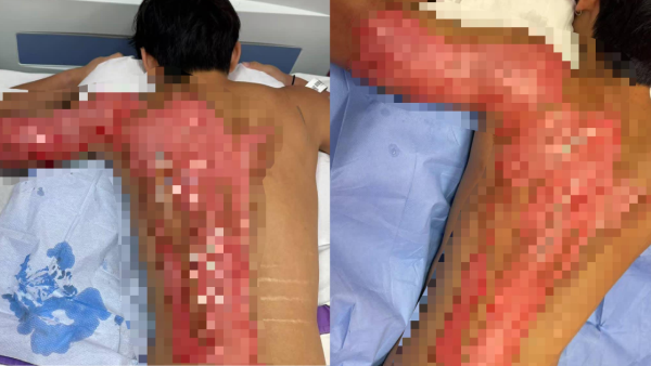 米線店燙傷19歲青年 背脊大面積二級灼傷 住院5日仍淌血水