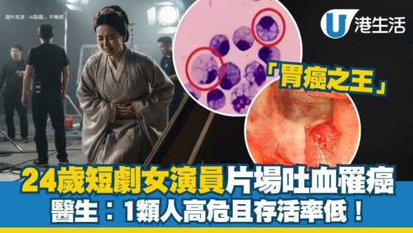 24歲短劇女演員片場吐血罹「胃癌之王」 醫生︰1類人高危且存活率低！