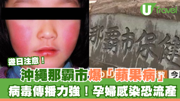 遊日注意！日本沖繩那霸市爆「蘋果病」病毒傳播力強暫無藥物可醫！孕婦感染恐流產
