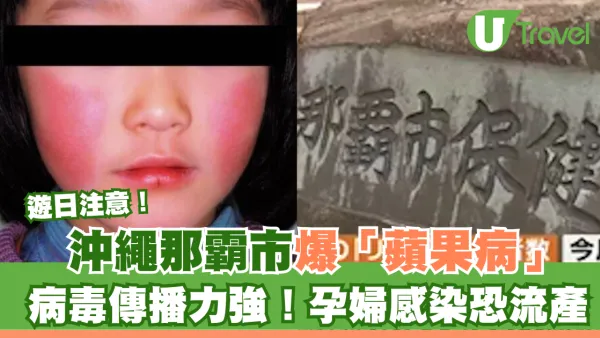 遊日注意！日本沖繩那霸市爆「蘋果病」病毒傳播力強暫無藥物可醫！孕婦感染恐流產