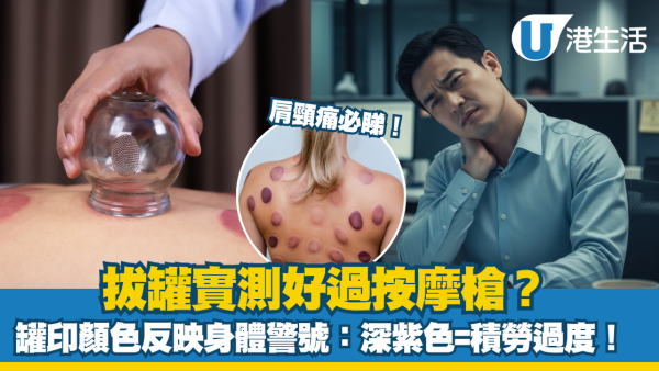 肩頸痛必睇!拔罐實測好過按摩槍?中醫拆解拔罐顏色身體警號:深紫色=積勞過度!