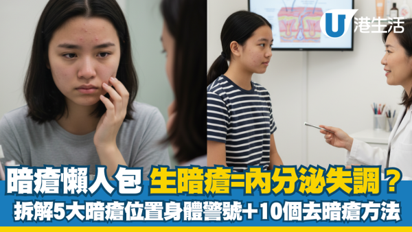暗瘡懶人包：額頭/下巴生暗瘡=內分泌失調？拆解5大暗瘡位置身體警號 + 去暗瘡方法