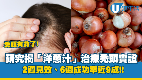 脫髮｜禿頭有救了？研究揭「洋蔥汁」治療禿頭實證：2週見效、6週成功率近9成！