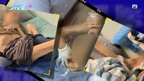 東張西望｜荃灣/元朗安老院變「虐老地獄」婆婆遭掐人中/長期綁腳！內幕曝光令人髮指