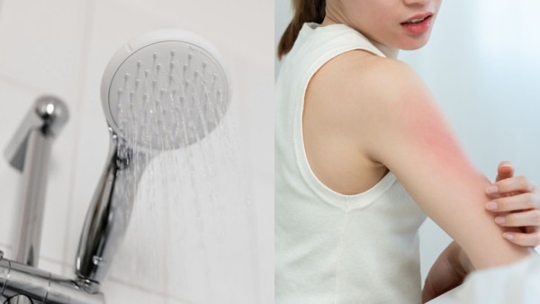 冬天沖熱水涼傷皮膚？醫生警告：超過15分鐘恐誘發皮膚炎　附3招急救止痕