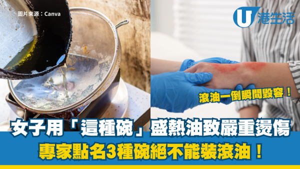 碗也會爆炸？滾油一倒瞬間毀容！女子用「這種碗」盛熱油致嚴重燙傷 專家點名3種碗絕不能裝滾油！