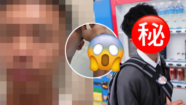 31歲男藝人IG晒恐怖燒傷驚見傷勢嚴重！佈滿血痕險毀容僅留一字惹網民擔心