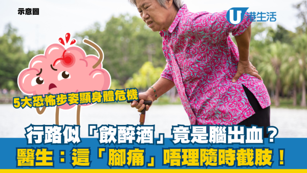 行路似「飲醉酒」竟是腦出血？醫生揭5大恐怖步姿：一類腳痛唔理隨時截肢！