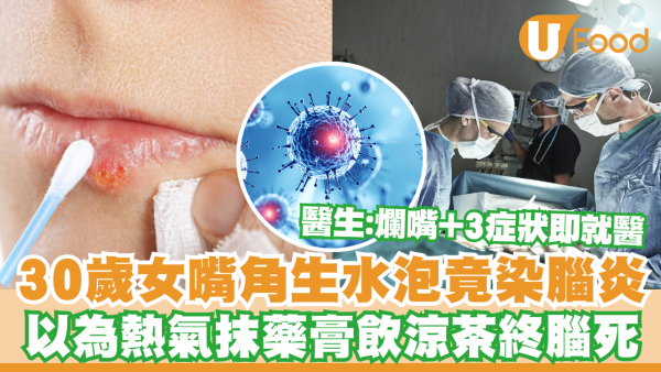 30歲女嘴角生水泡竟是腦炎症狀！以為熱氣沒重視終不治／醫生：爛嘴伴隨3症狀要即就醫
