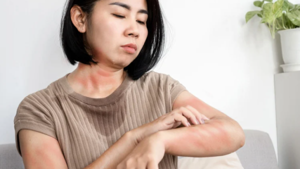 港大研發「濕疹神藥」賣斷貨！屈臣氏限購$228起 實測：改善重度濕疹免依賴類固醇