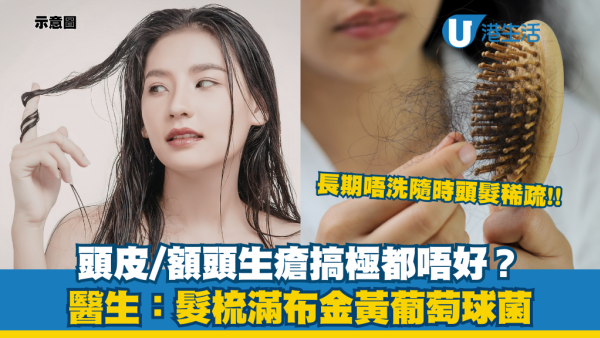 額頭生瘡搞極都唔好？醫生揭元兇係髮梳！上面滿布金黃葡萄球菌：長期唔洗隨時頭髮稀疏