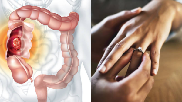 38歲男剛求婚成功後確診未期大腸癌  醫生：已擴散至肝臟／附6大隱形先兆