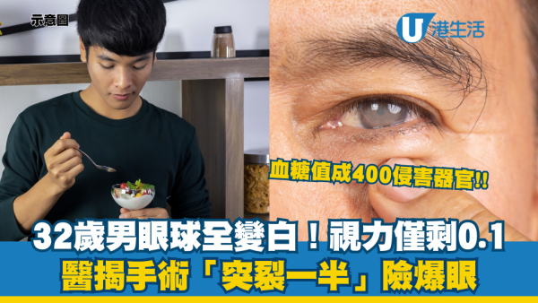 32歲男血糖失控眼球全變白！糖尿病致白內障 視力剩0.1！醫生揭手術中險爆眼 附白內障7大成因及初期徵兆