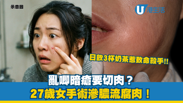 亂唧暗瘡要切肉？27歲女手術驚見「滲膿流腐肉」！醫生揭：一款飲品成致命殺手