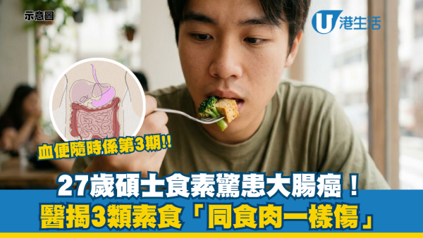 食素都中招？27歲碩士驚患大腸癌！醫生警告揭3類素食「有毒」致癌 5大高危族必睇