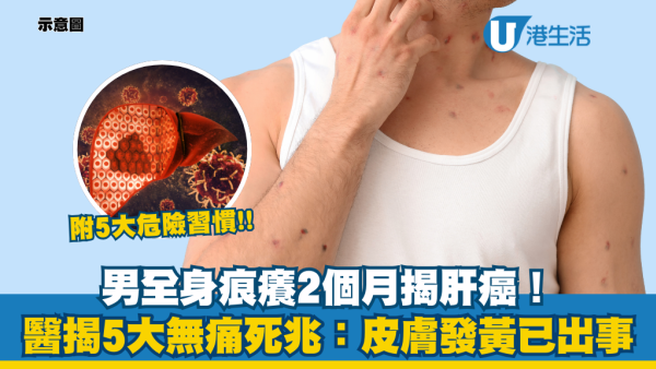全身痕癢以為過敏？內地男驚揭患肝癌！醫生警告5大無痛徵兆：眼白見黃已出事！附5大危險習慣