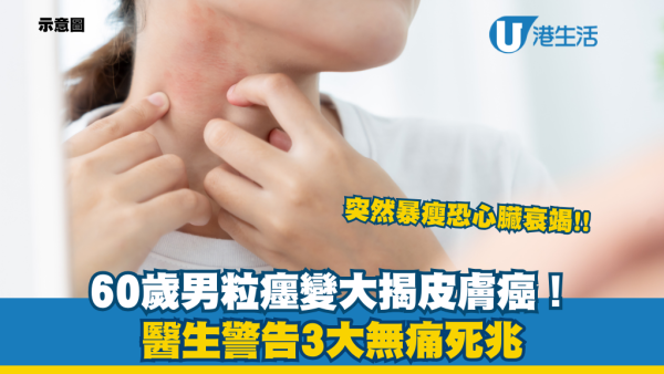60歲男突生大粒癦驚揭皮膚癌！醫生警告3大無痛死兆：50歲後出黑斑要留神 暴瘦恐心臟衰竭