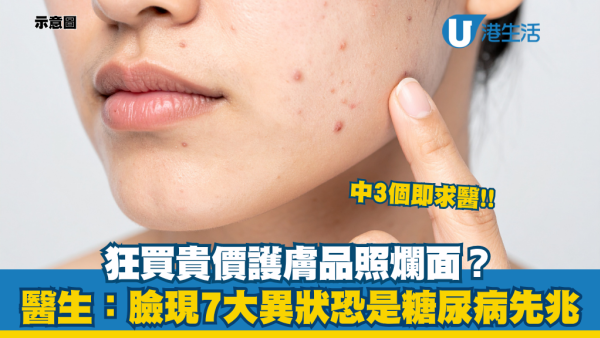 糖尿病｜生暗瘡唔一定係皮膚問題！醫生揭7大臉部徵兆恐血糖失控！警告：中3個即求醫