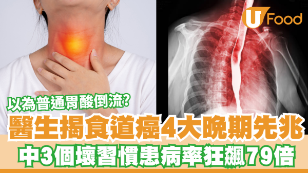 以為普通胃酸倒流？醫生揭食道癌4大晚期先兆！中齊3個壞習慣患病率狂飆79倍